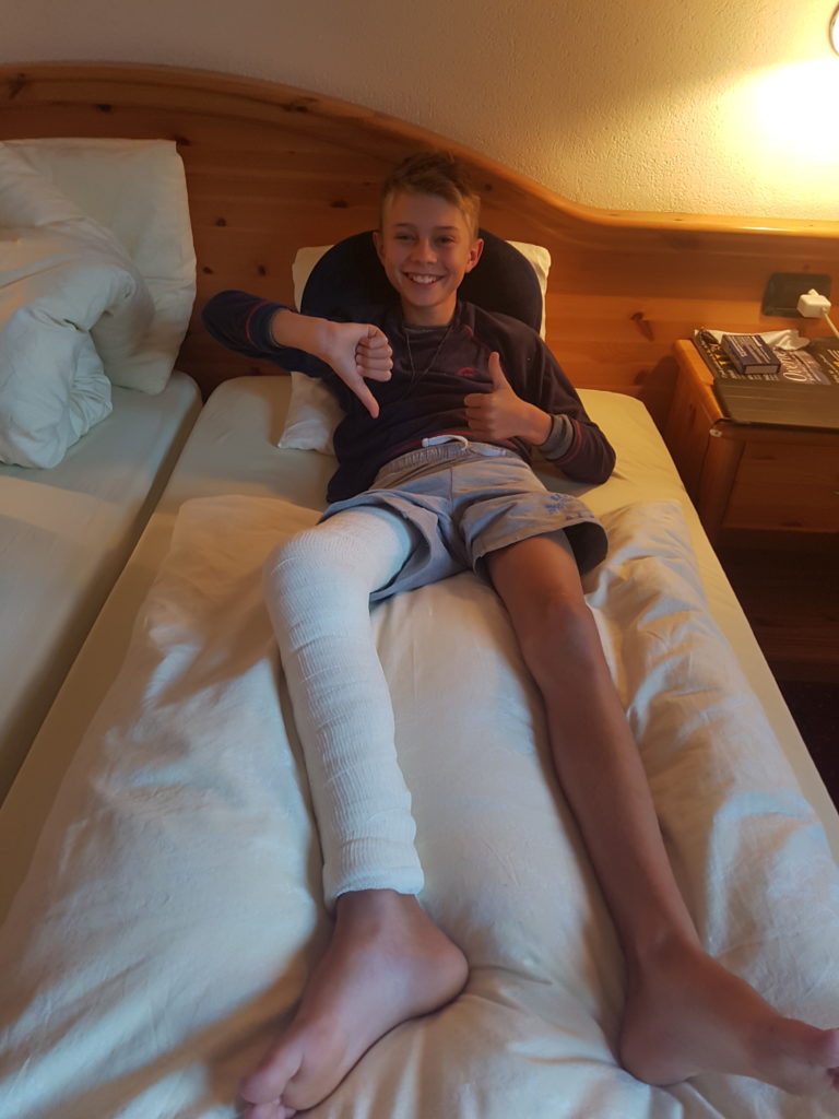 Menino sorrindo na cama, com a perna quebrada. Imagem ilustrativa texto criança quebrou o braço.